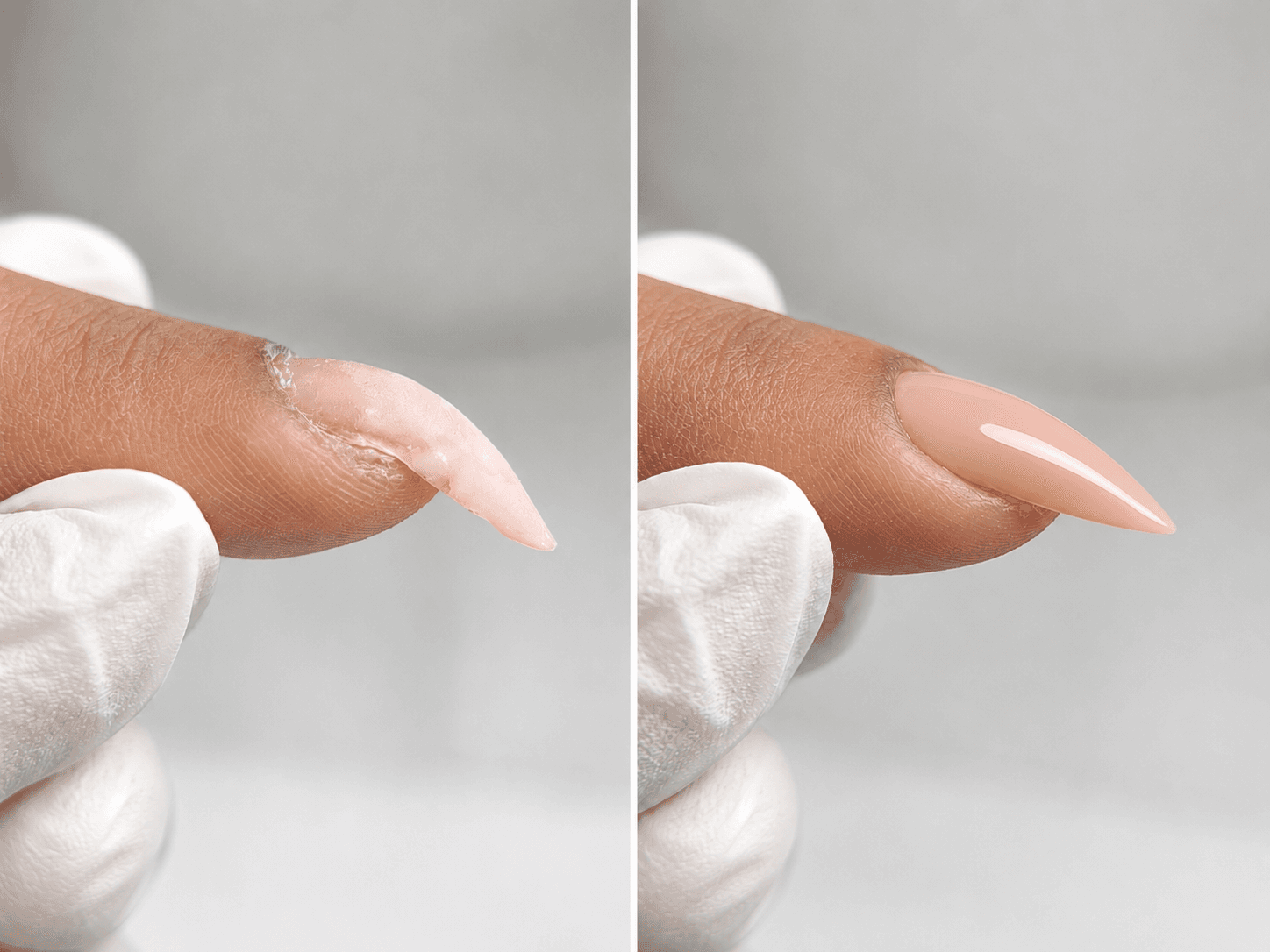 Before / After: Nails that grow downward or “hook”