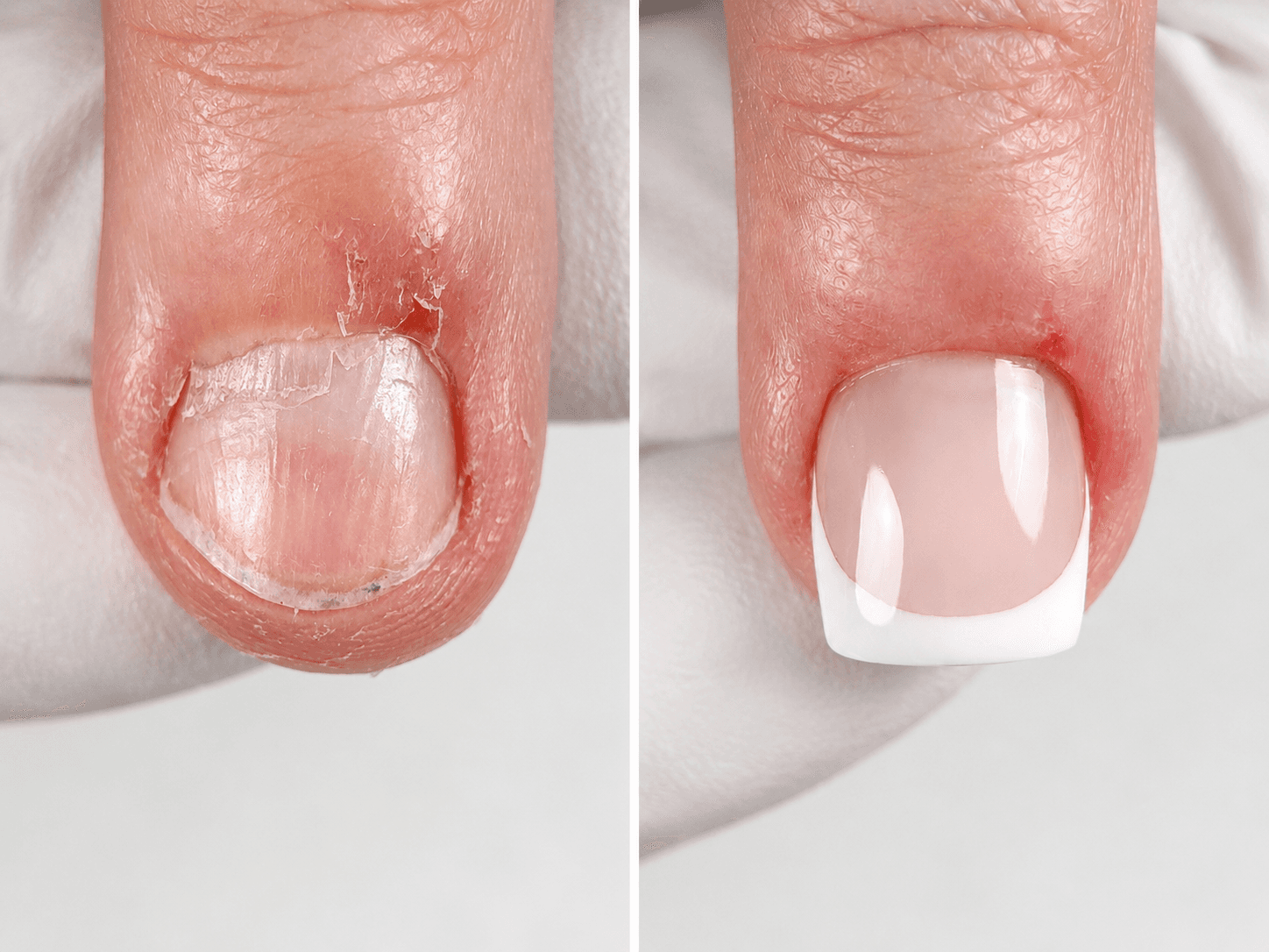 Before / After: A thin cuticle that’s easy to injure